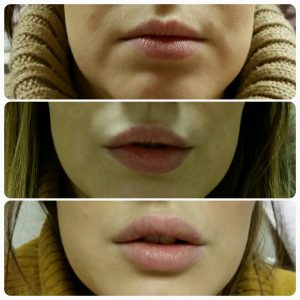 staged lip fillers dr wilson 1