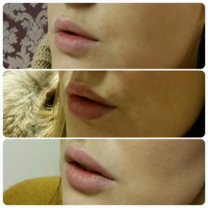 staged lip fillers dr wilson