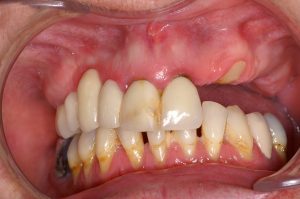 upper dental implants before