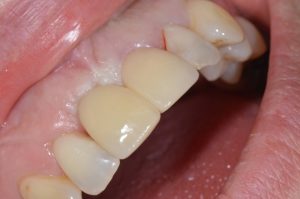 Dental implant crown