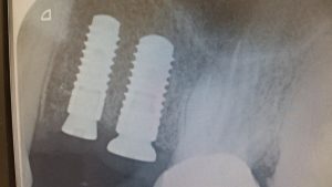 dental implants radiograph