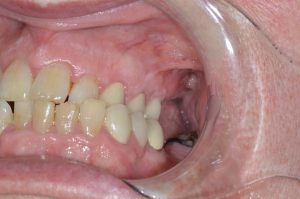 missing molar teeth