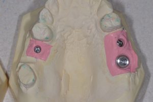 dental implant positioning