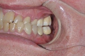 dental implants to replace molar teeth