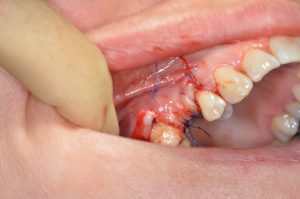 dental implant stitches