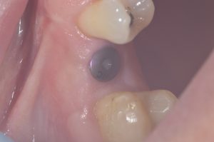 dental implant healing abutment