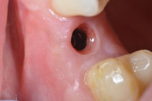 Dental implant gum healing