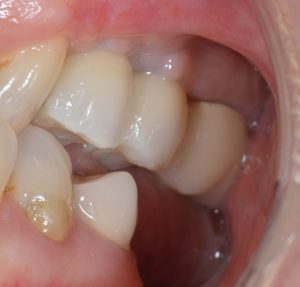dental implant premolars