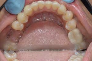 missing molar occlusal
