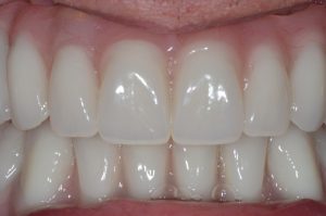 After Dental Implants 2