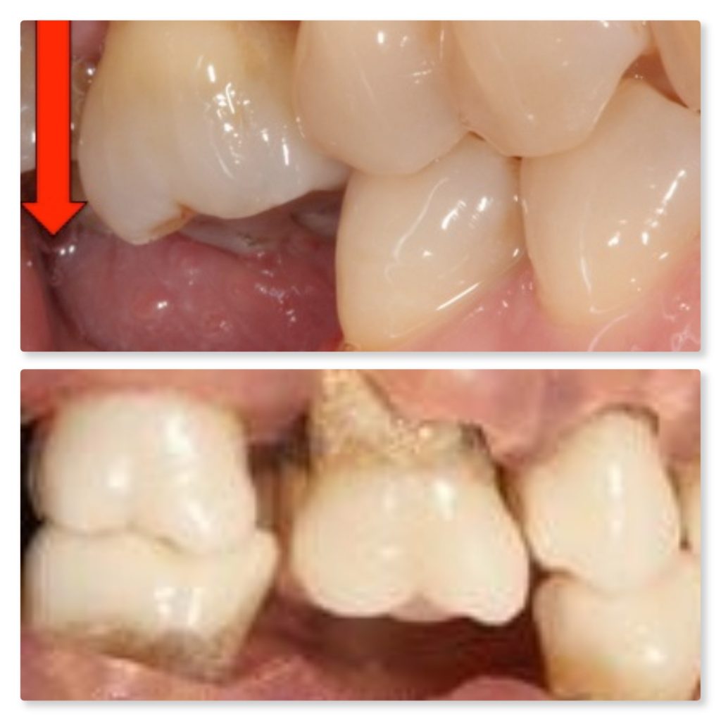 Preventing overeruption and drifting following tooth loss Dental