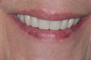 dental implant teeth