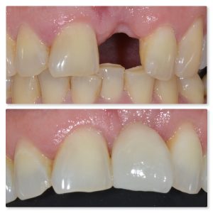 natural looking dental implant tooth