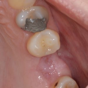 missing tooth and fractured amalgam