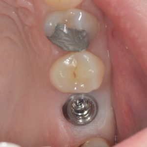 Dental implant healing after phase 1