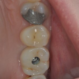 Dental implant screwed in for long term ease of maintenance
