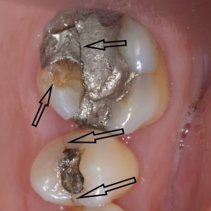 tooth fracture amalgam