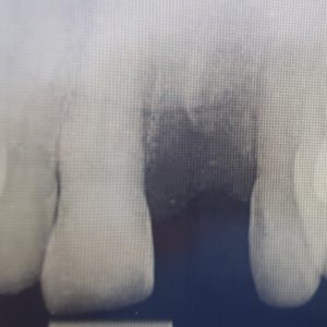 missing tooth, bone loss