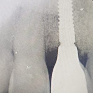dental implant radiograph