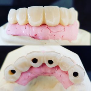 Dental implants infinity Dental Clinic