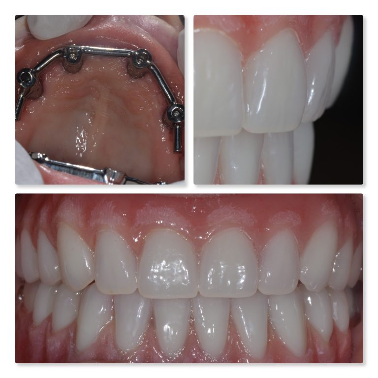 Rigid and aesthetic replacement teeth Dental Implants, Bars and Teeth