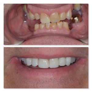 before and after dental implants with composite bonding