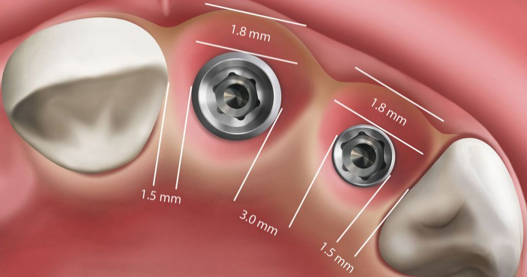 implant positioning Infinity Dental Clinic