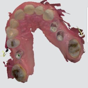 Digital Intra-Oral Scan of Dental Implants using Scan Bodies