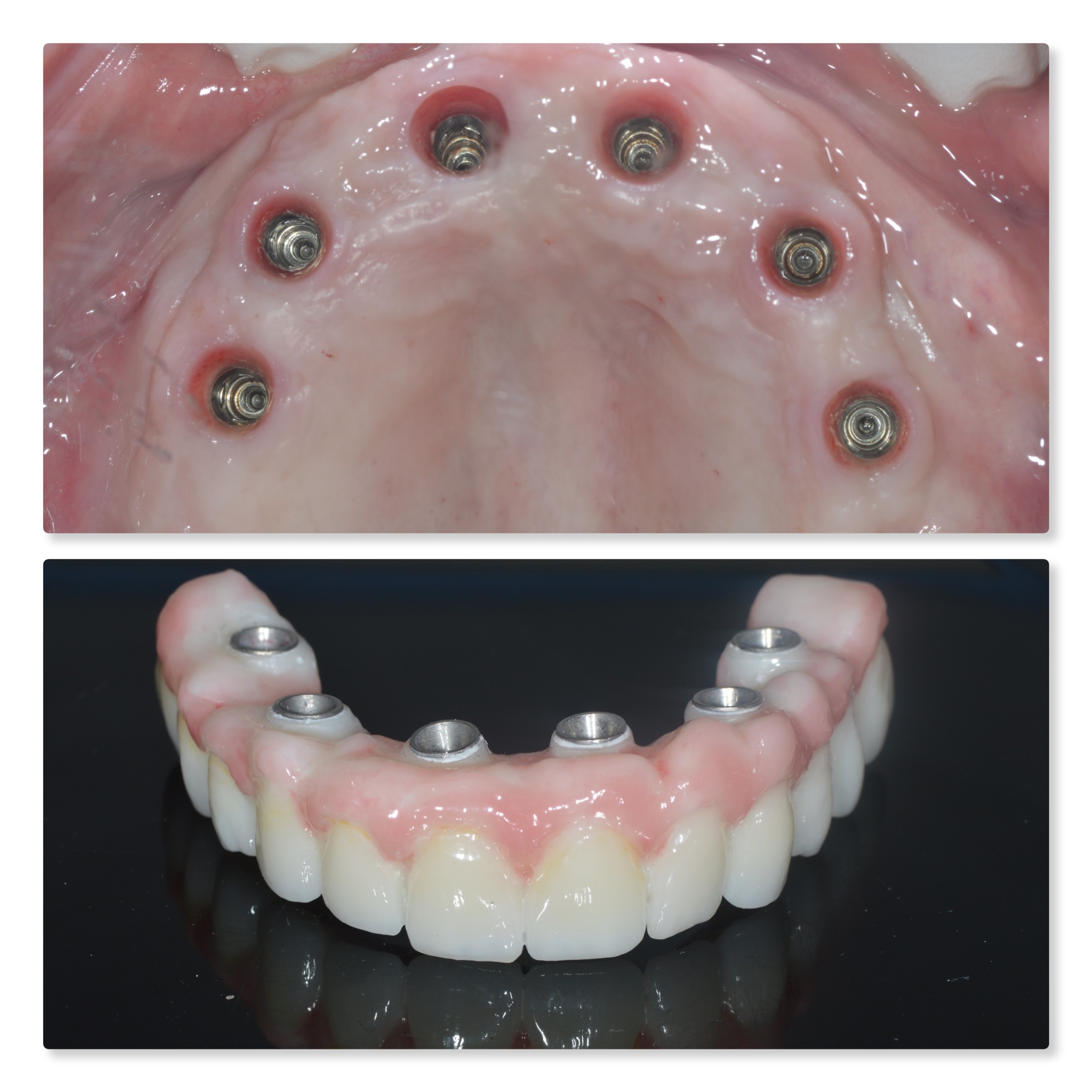 A full-arch implant-supported zirconia prosthesis