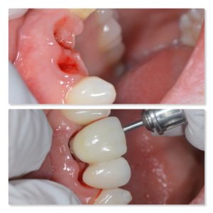 gum contouring infinity dental clinic