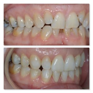 invisalign orthodontics infinity dental clinic