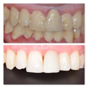 gum surgery crown lengthening and dental implant