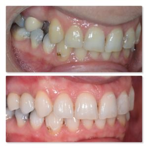 premolar dental implant infinity dental clinic mohsin patel