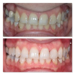 premolar dental implant infinity dental clinic mohsin patel 2