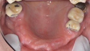 missing upper anterior teeth occlusal view