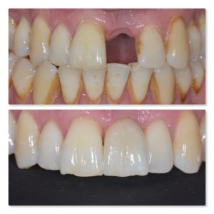 Replacing an upper left central incisor with a dental implant Leeds