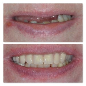 implant retained denture upper arch infinity dental clinic leeds