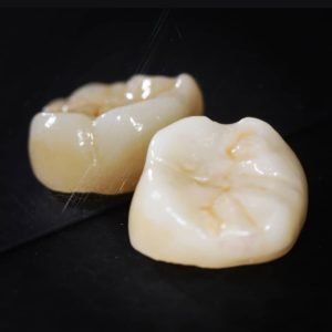 Ceramic crown with precision milling, Infinity Dental Clinic Leeds
