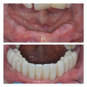 lower full arch fixed dental implants