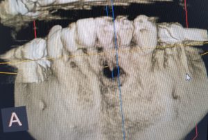 CBCT scan bone defect