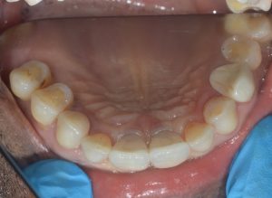 Occlusal view of central implant Dr mohsin Patel