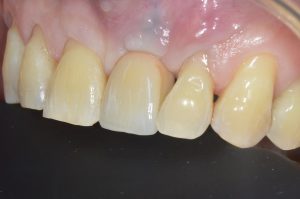 UL1 restored dental implant straumann