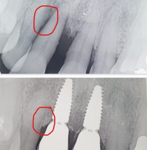 Infinity Dental Clinic bone grafting dental implants