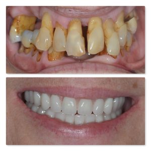 Secret insights into Full Mouth Dental Implants