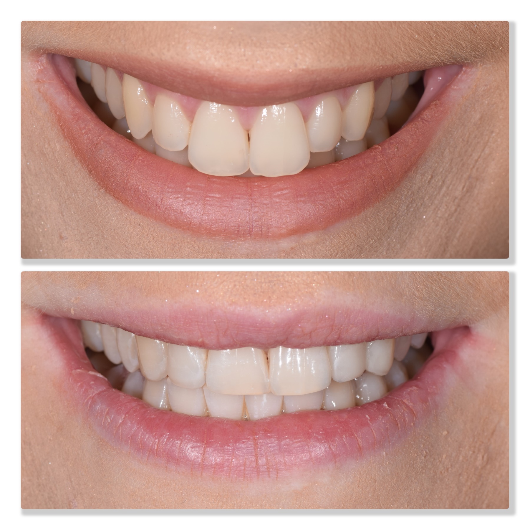 Composite bonding 3 Infinity Dental Clinic