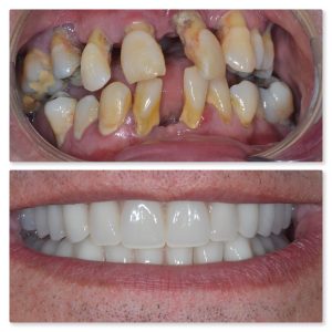 Implant retained denture