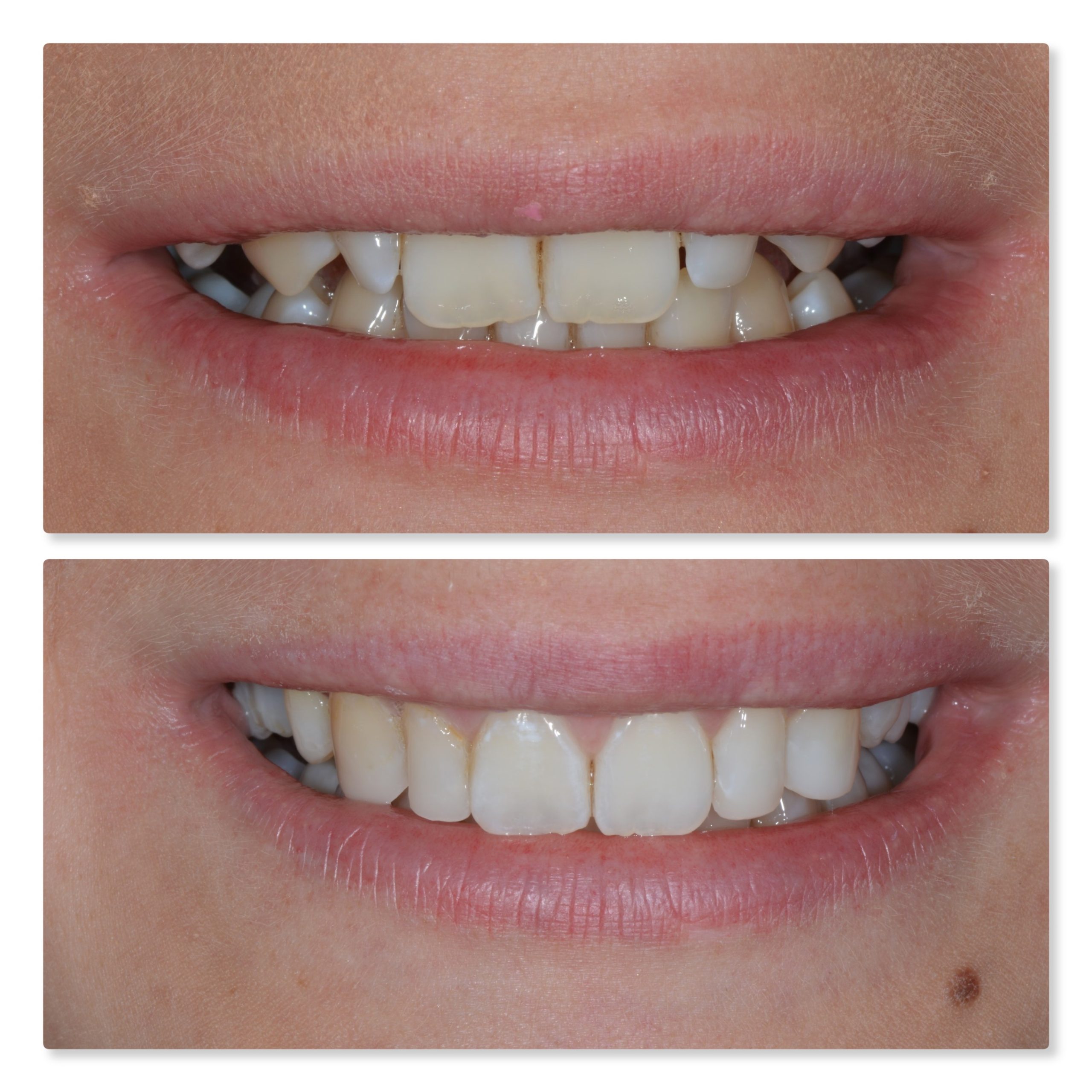 invisalign and composite bonding 2 Infinity Dental Clinic