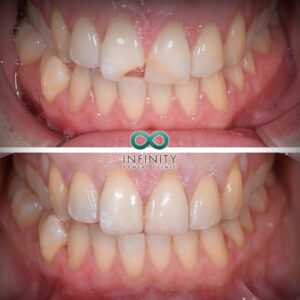 This fractured UR1 was repaired using composite to restore this patient's confidence and smile within a 60 minute appointment!