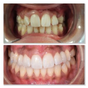 Invisalign and Implant 