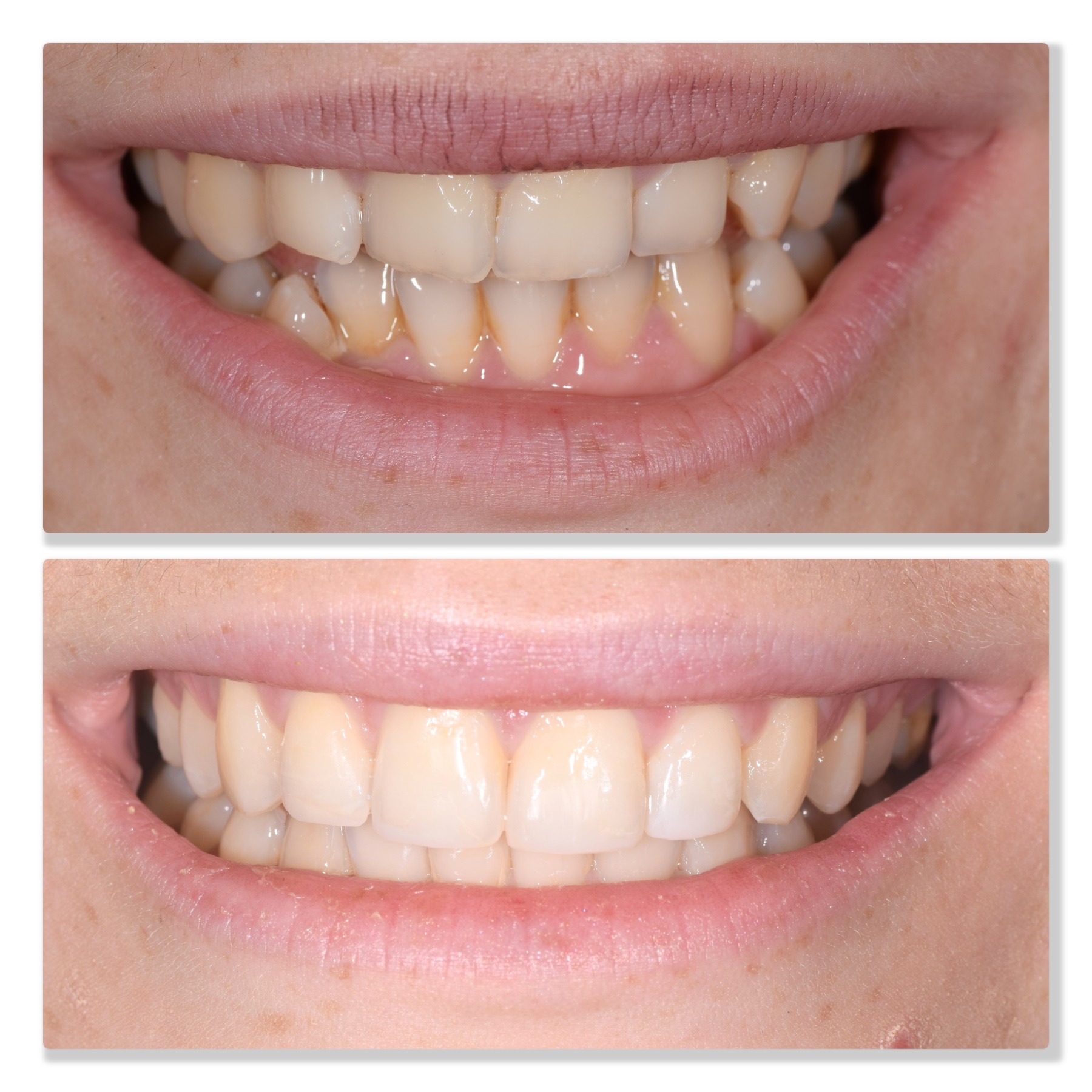 Invisalign and composite bonding 1 Infinity Dental Clinic